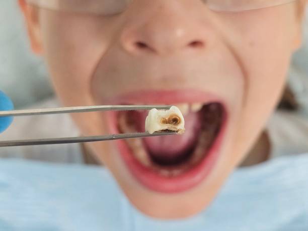 Urgent Tooth Repair in CT